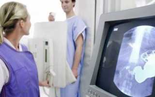 Рентгенография грудной клетки: показания к проведению диагностики