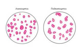 Гипохромия, или гипохромная анемия: особенности протекания и лечения