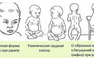 Все о рахите у грудных детей: симптомы, причины, лечение (профилактика и витамины). последствия рахита