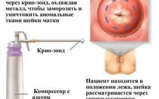 Удаление полипов в матке: гистероскопия, послеоперационный режим