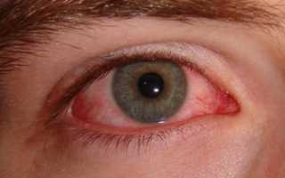 Что делать, если болят глаза от сварки?